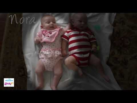 Learn to Spot the Warning Signs of SMA – Frog-Like Leg Position (Video 3)