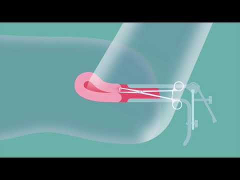 IUD Procedure with Tenaculum
