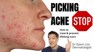 Picking acne | How to treat to prevent lifelong scars