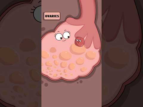 How are chocolate cysts formed? #health#didyouknow#shorts#funny#trending