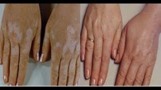 Sedef-Vitiligo ve Cilt Hastalıklarına Okunacak Ayet-i Kerim | Kayıp Dualar
