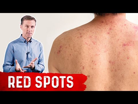 Why Red Spots on My Skin – Dr.Berg on Skin Red Spots Causes & Remedies