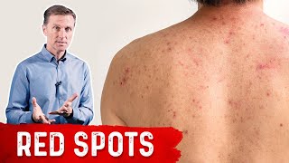 Why Red Spots on My Skin – Dr.Berg on Skin Red Spots Causes & Remedies