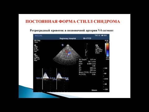Сегментарный остеохондроз межпозвонковых дисков Боль в пояснице после тренировок