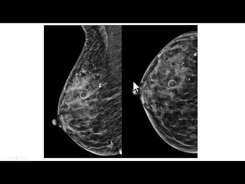 Achados mamográficos em vítima de acidente de moto.