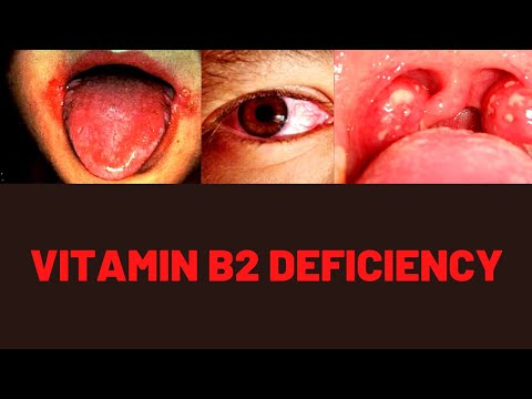 VITAMIN B2 BENEFITS, FOOD SOURCES, DEFICIENCY SYMPTOMS