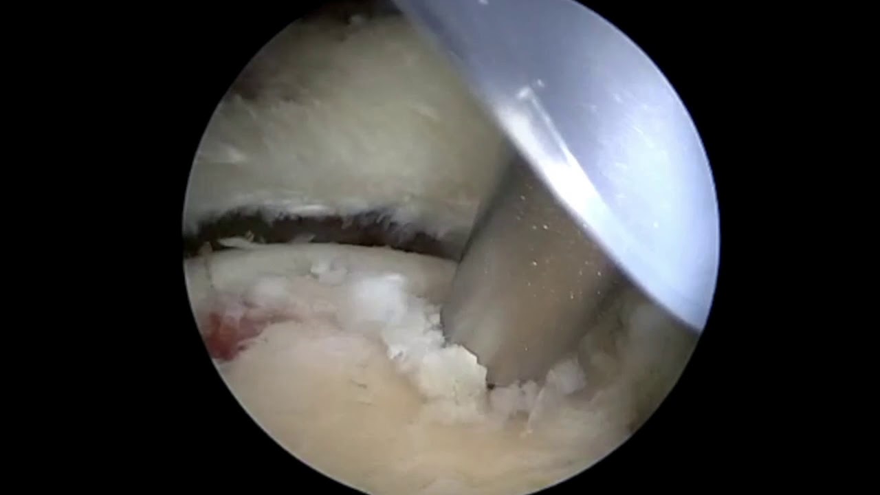 Dr. Garcia demonstrates his technique for arthroscopic rotator cuff repair.