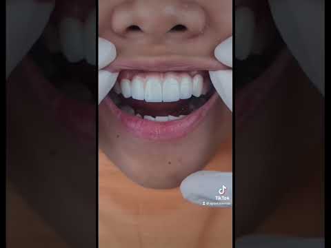 Zirconia fixed bridge for the win! #apostolified #dentist #smile