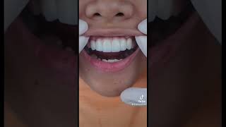 Download lagu Zirconia fixed bridge for the win! #apostolified #dentist #smile mp3