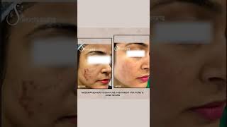 Medimakeovers Signature Treatment for Acne & Acne Scars | Dr Suruchi Puri | Acne Problems | #Shorts