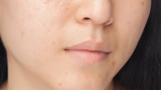 How to Get Rid of Blackheads Overnight