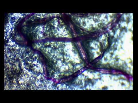 My Morgellons Symptoms -  Fiber Footage