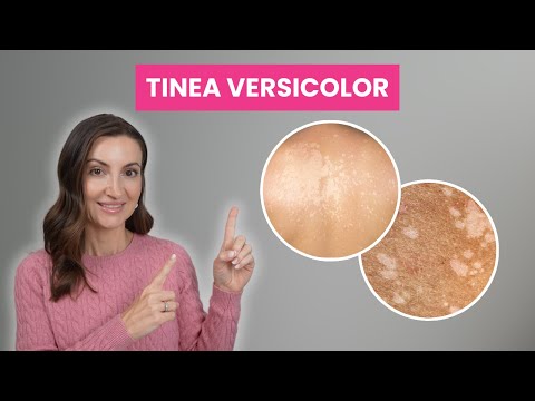Tinea Versicolor: Causes, Treatments, and How to Stop It from Coming Back | Dermatologist Explains