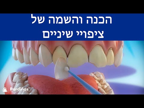 © ציפויי שיניים – הכנה והשמה