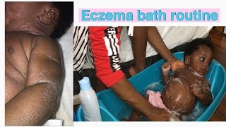 Eczema Bath Rroutine | how to get rid of and treat baby eczema, dry skin, rash