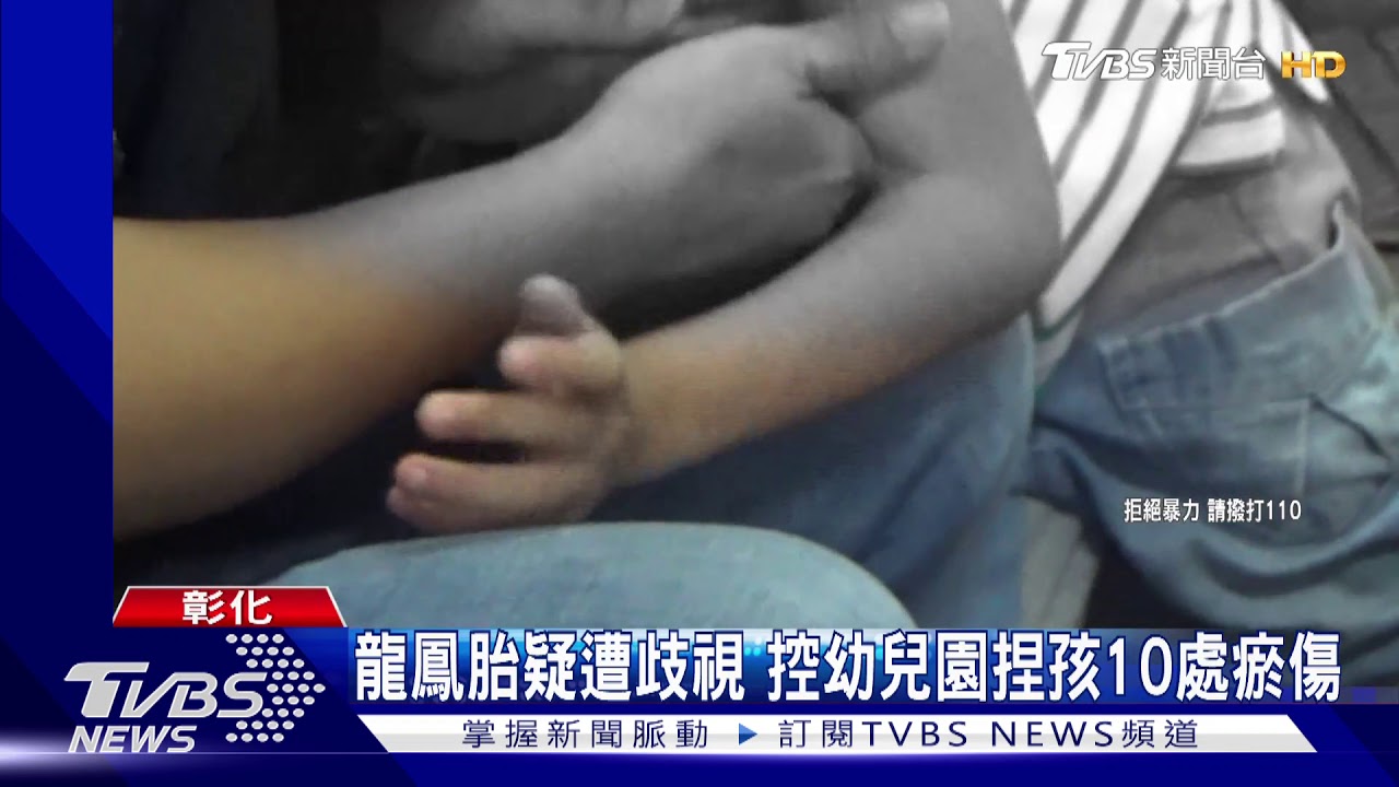 龍鳳胎疑遭歧視 控幼兒園捏孩10處瘀傷