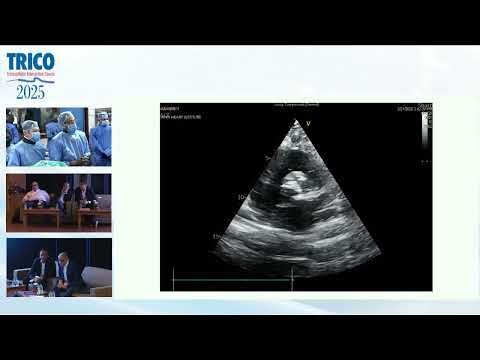 Mastering TAVR: Live Case by Dr. Aman Patel, Dr. Sanjay Shah & Dr. Abdurashid | TRICO 2025