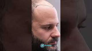 Hair Transplant Surgery in Istanbul