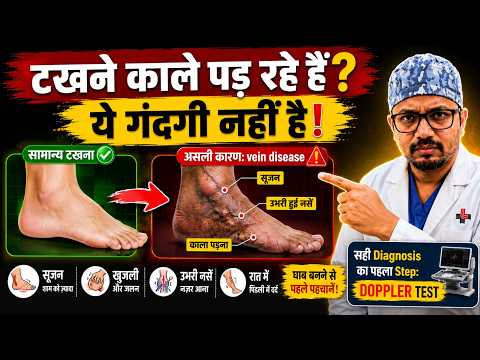 टखने काले क्यों पड़ रहे हैं? क्रीम क्यों नहीं काम करती - Venous Pigmentation