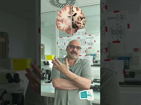 La maladie d'Alzheimer   démêlons le vrai du faux