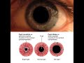 #Eyes#Pupil Reflexes#shorts