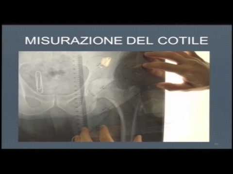 La qualità della vita dopo la sostituzione articolare Mi fa male tutto il collo e la tosse