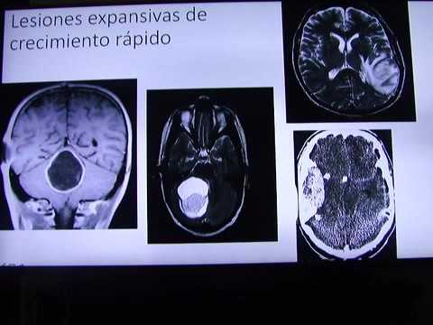 Menopausia presión arterial Nuevos fármacos para el tratamiento de la hipertensión