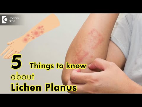 hogyan kell kezelni a lichen planus foltokat