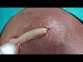 Massive Abscess Drainage