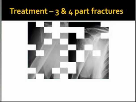 Dr James Churchill - Proximal Humeral Fractures