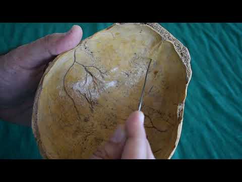 Osteology of Skull Cap- calvarium