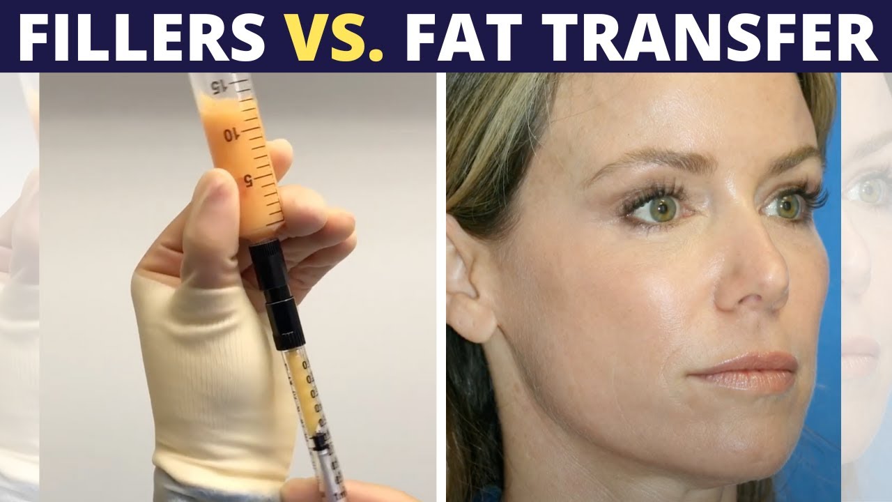 Fat Transfer vs. Fillers | What's the Difference?