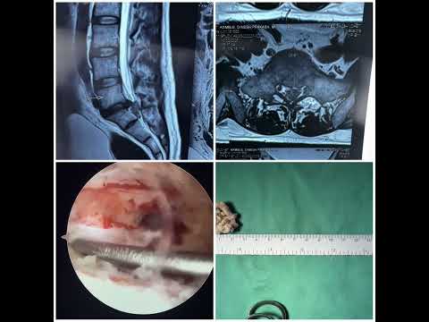 Lumbar spine slip disc equina syndrome treated with endoscopic spine surgery #laser #miss
