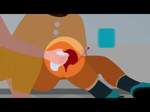 How to Stop Bleeding in an Emergency | UPMC Minutes Matter