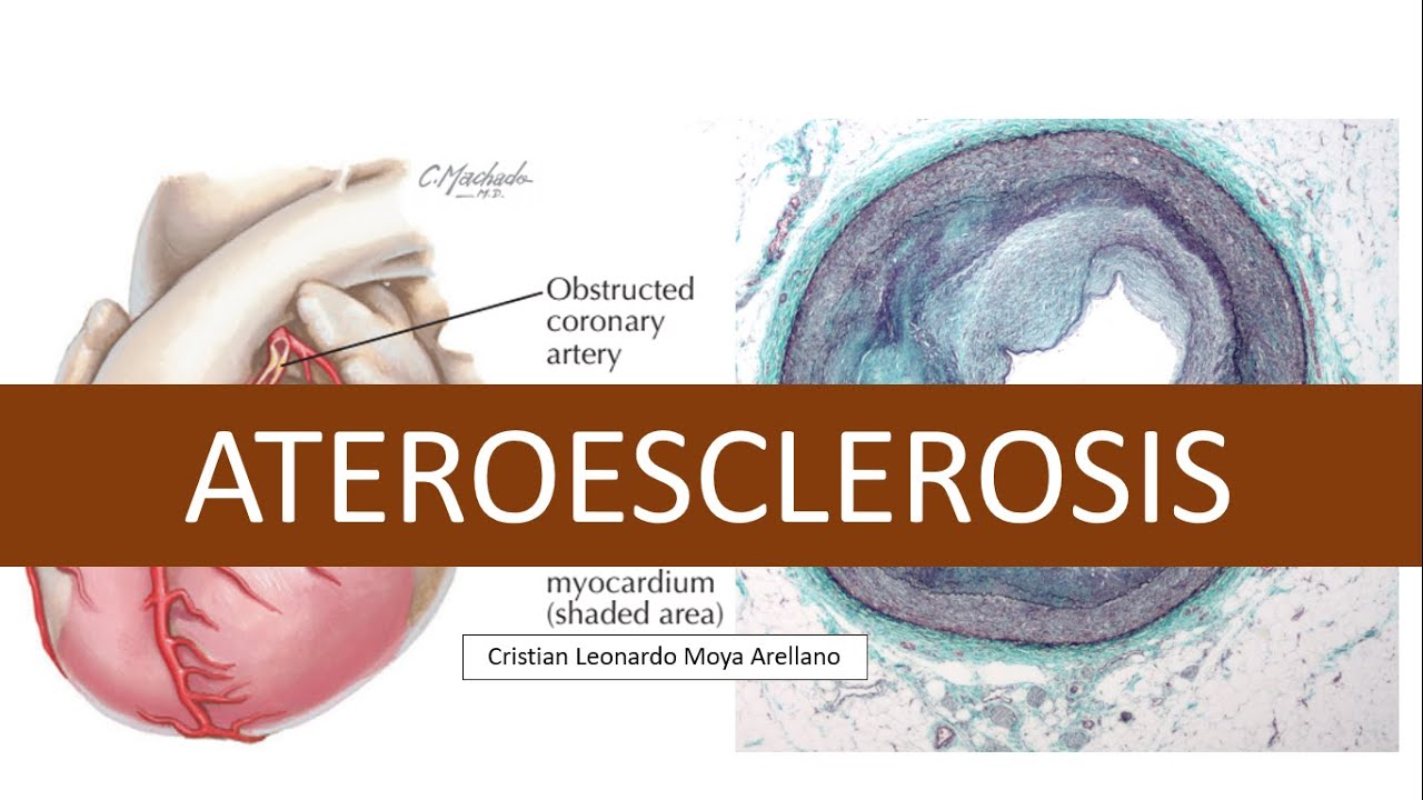 ✅ ATEROESCLEROSIS: ¿QUÉ ES?, ¿POR QUÉ SE DA? ¿Y CUÁLES SON SUS COMPLICACIONES?