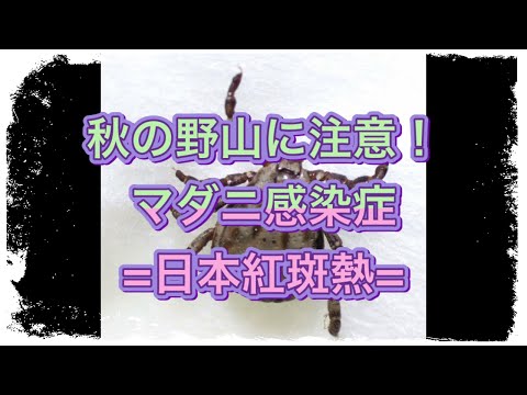 ロッキー山紅斑熱について詳しく解説