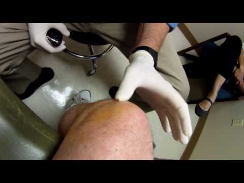 Hyalgan pfs 20mg injection 2ml, sodium hyaluronate e.p.