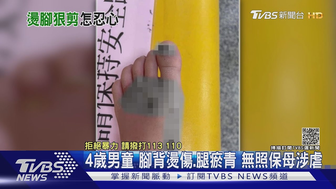 4歲男童腳背燙傷、腿瘀青 無照保母涉虐