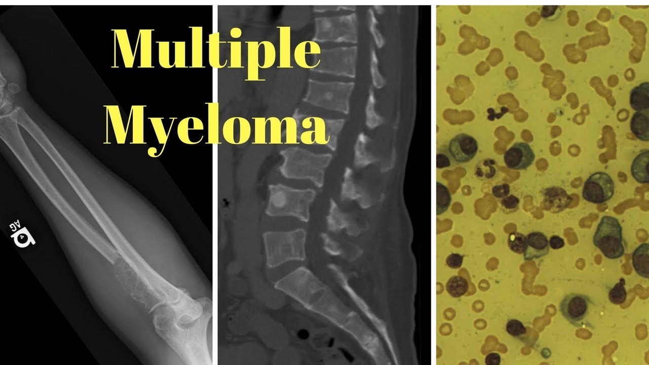 Multiple myeloma end stage