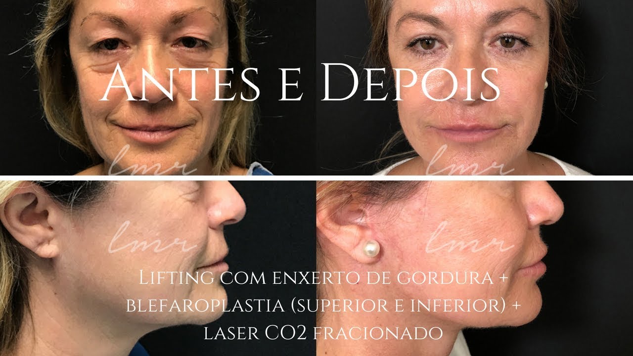 Antes e Depois - Lifting Facial, Blefaroplastia e Laser Fracionado CO2 -  LMR Cirurgia Plástica