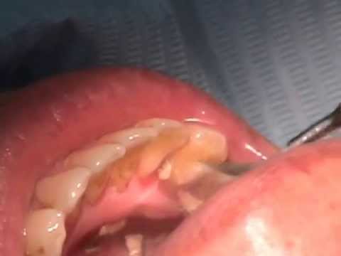 ขูดหินปูน