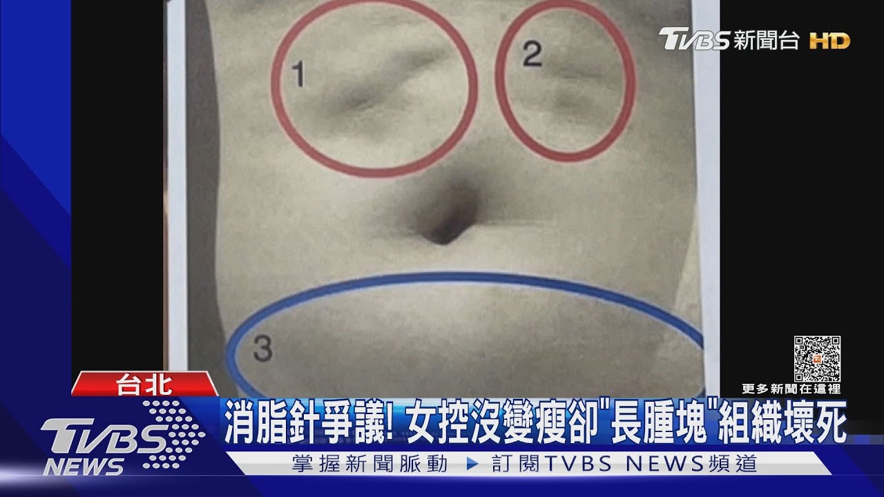 消脂針爭議!女控沒變瘦卻「長腫塊」 組織壞死
