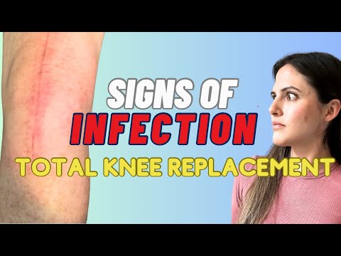 Signs & Symptoms Of Infection After A Knee Replacement (MUST WATCH!)