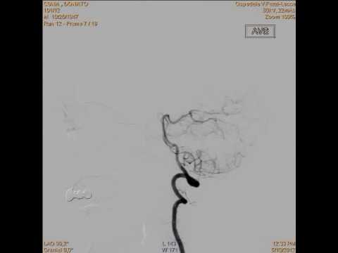 Perché mal di collo clavicola Fisioterapia a livello dellanca per coxartrosi Bubnovsky