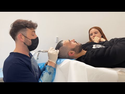 I WILL NO LONGER BE BALD - My experience with TRICOPIGMENTATION || JASER