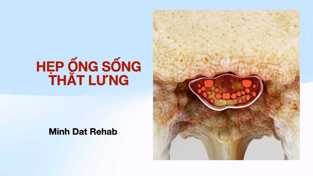 Hẹp Ống Sống Thắt Lưng
