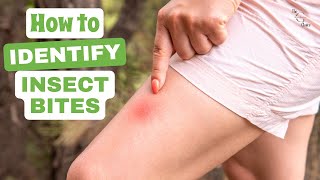 How to Identify Insect Bites: A Comprehensive Guide to Recognizing Common Bug Bites