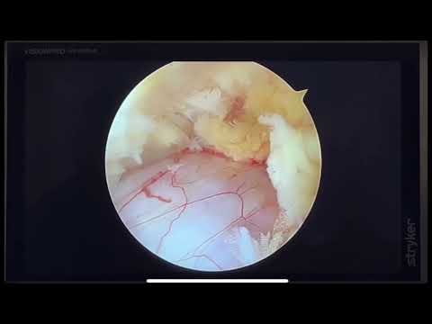How is lumbar spine endoscopic discectomy performed