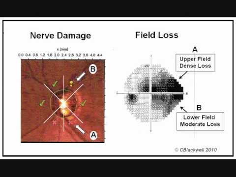 Jaskra cz.1 - diagnostyka