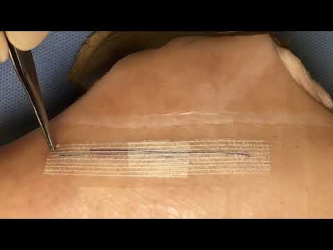 SUTURE REMOVAL - SUBCUT